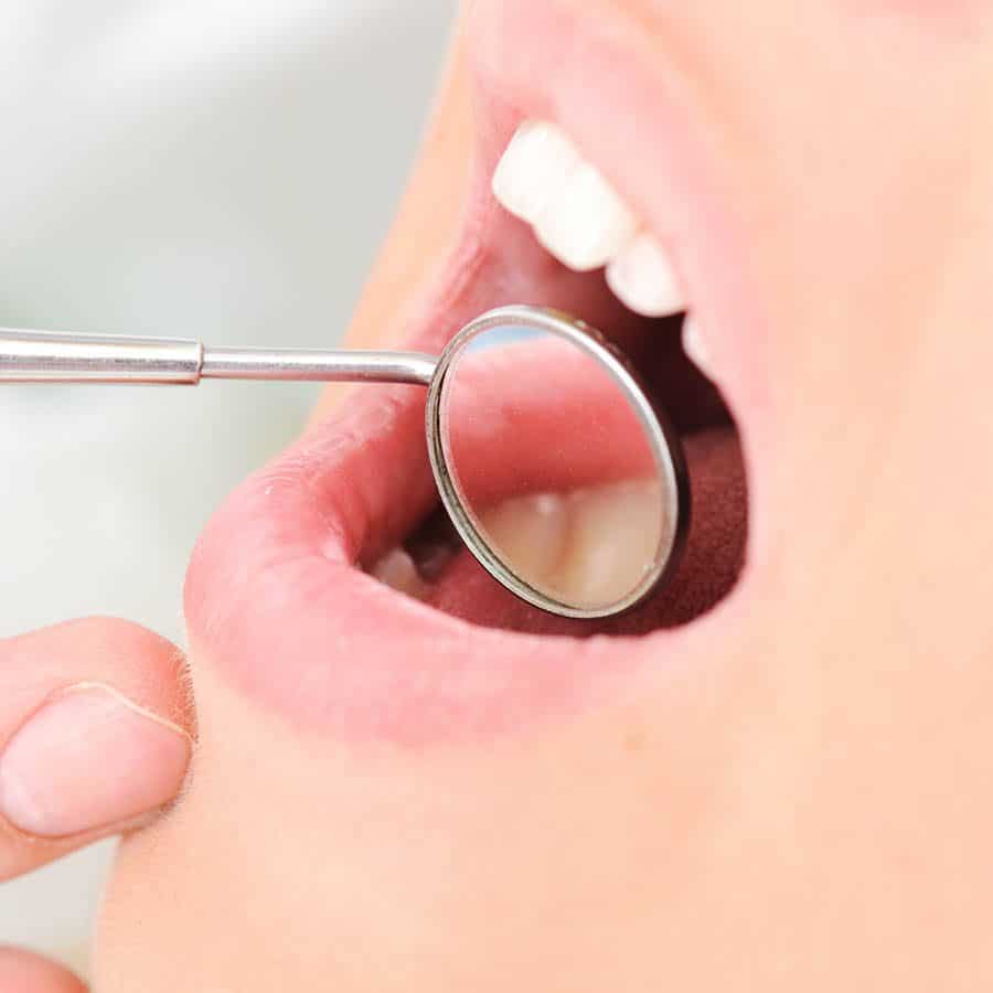 A close-up of an open mouth with a dental mirror reflecting the teeth, likely during a dental examination.